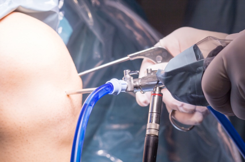 Arthroscopy