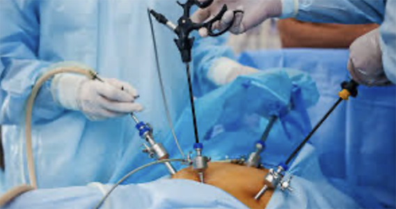 Laparoscopy